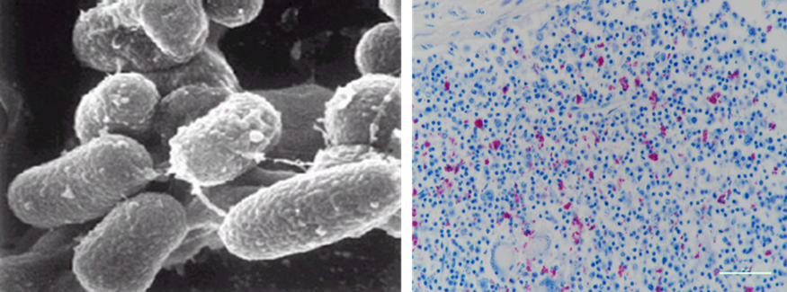 Tuberculosis
